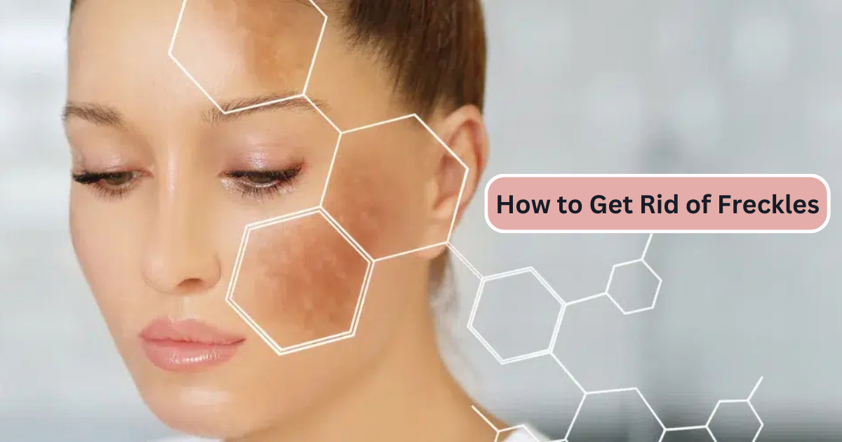 How to Get Rid of Freckles